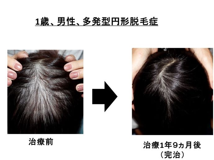 円形脱毛症　病院